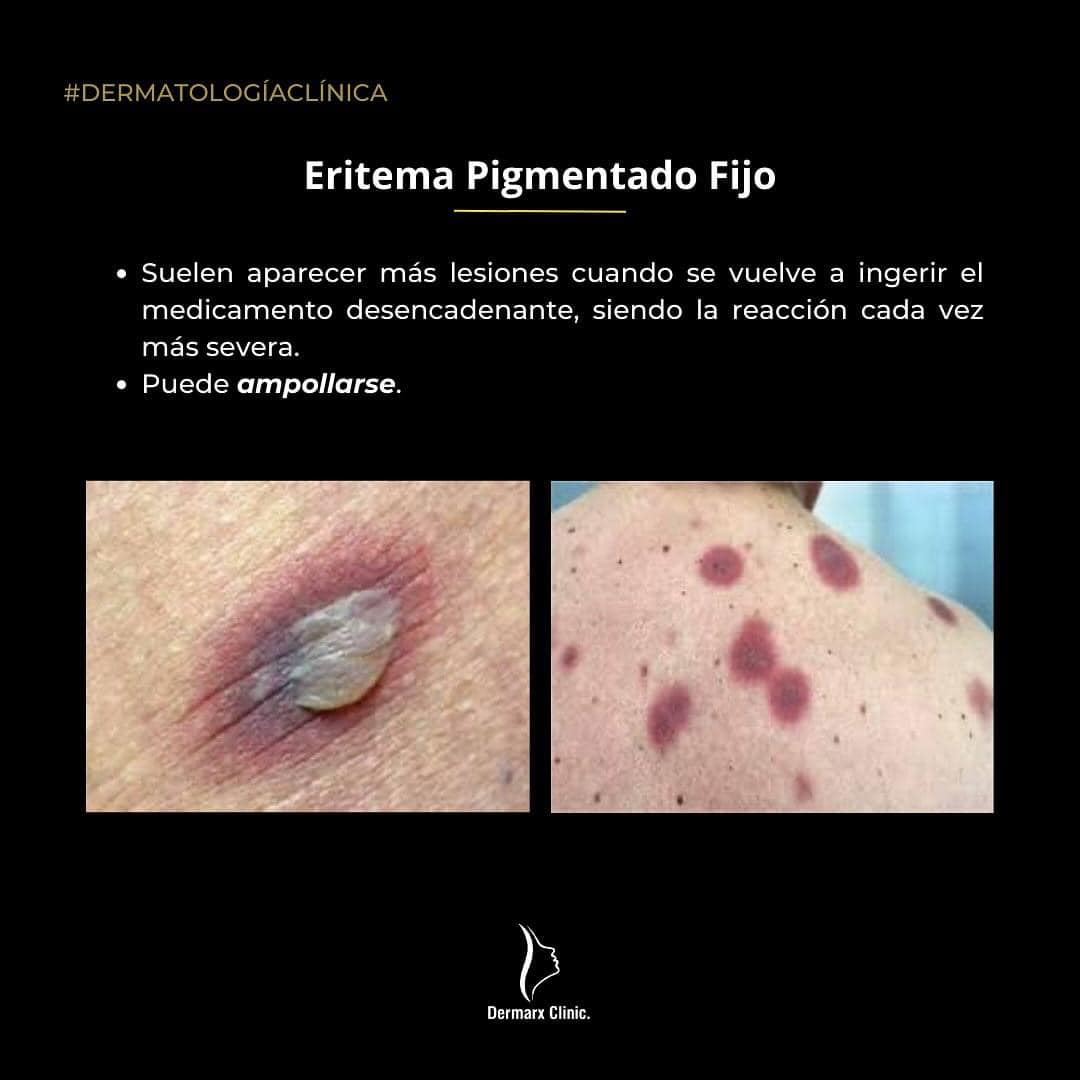 Dermarx clinic - El eritema pigmentado fijo es una forma...