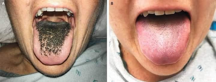 melanotic tongue melanotic Congenital Melanotic Macule of the Tongue: Report of Two Cases and Literature Review congenital melanotic macule of the