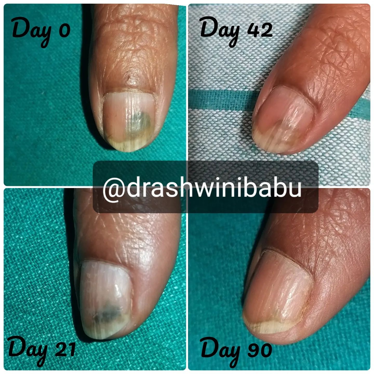 Dr - 56 year lady came complaining of itchy rashes over the leg, she ...