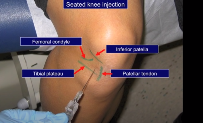 knee injection technique 1.ANTEROLATERAL approach 2.MEDIAL mid patellar ...