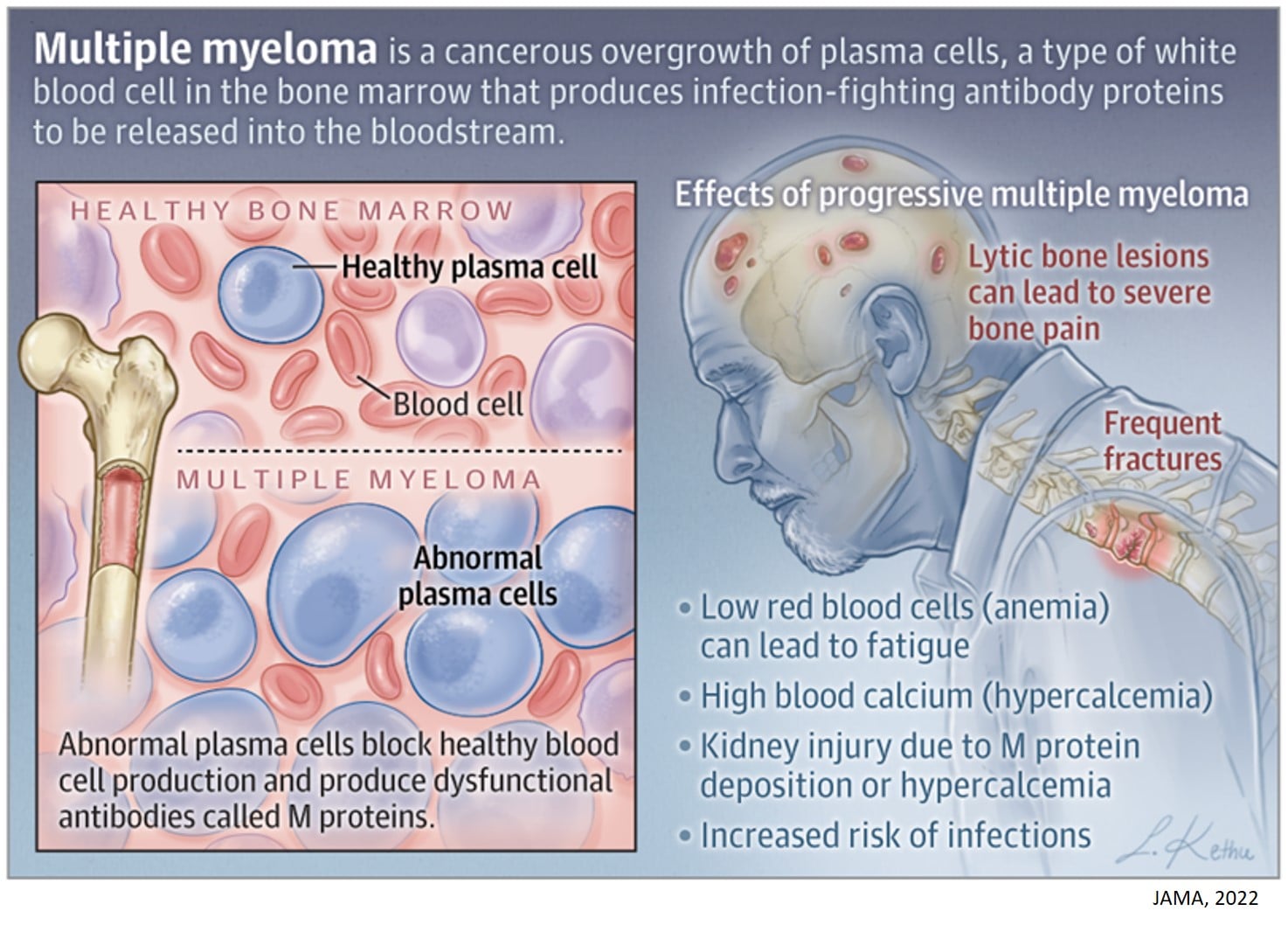 Plasma Cell In Multiple Myeloma