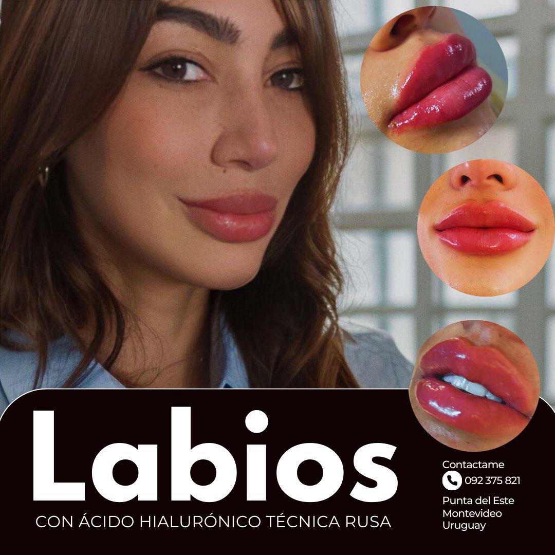 Ácido Hialurónico Aumento y Perfilado Labial, Botox Facial | Montevideo