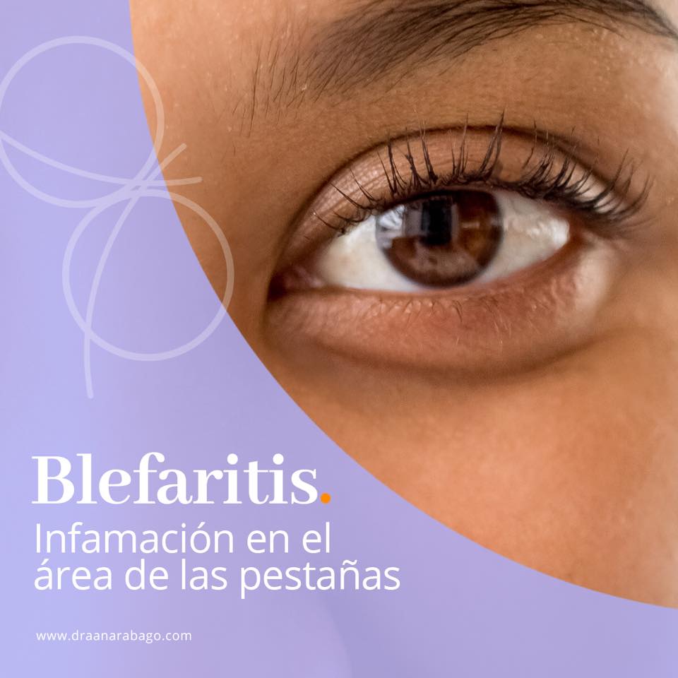 Blefaritis Es una condición que causa... - Doctora Ana Rábago