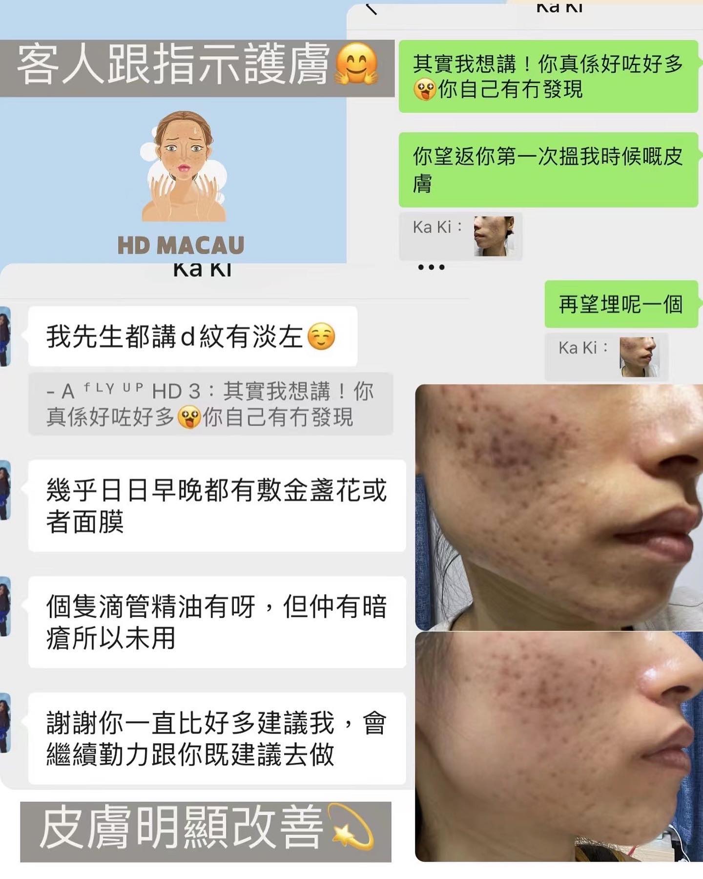 FLY UP HD Macau - 逆轉勝就這麼容易🔥僅僅2星期變化已經夠振奮人心‼️這前後圖僅僅好了一半、還有50%...