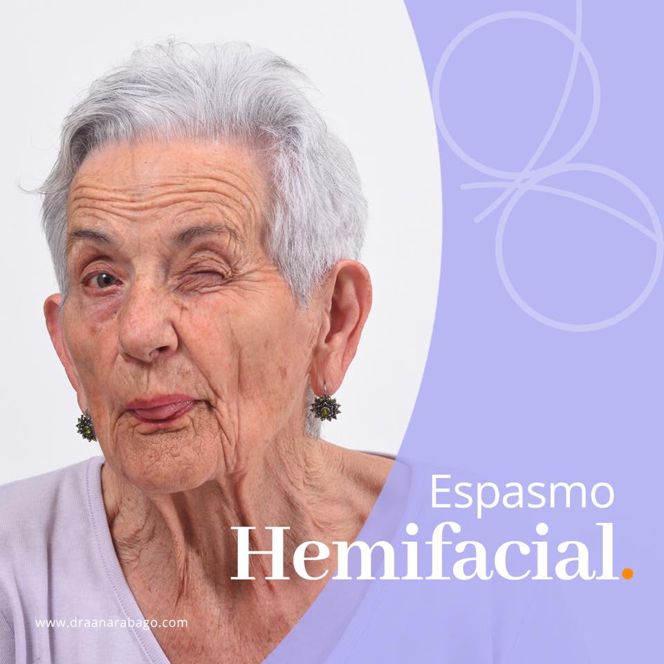 Espasmo Hemifacial Es una condición... - Doctora Ana Rábago | Facebook