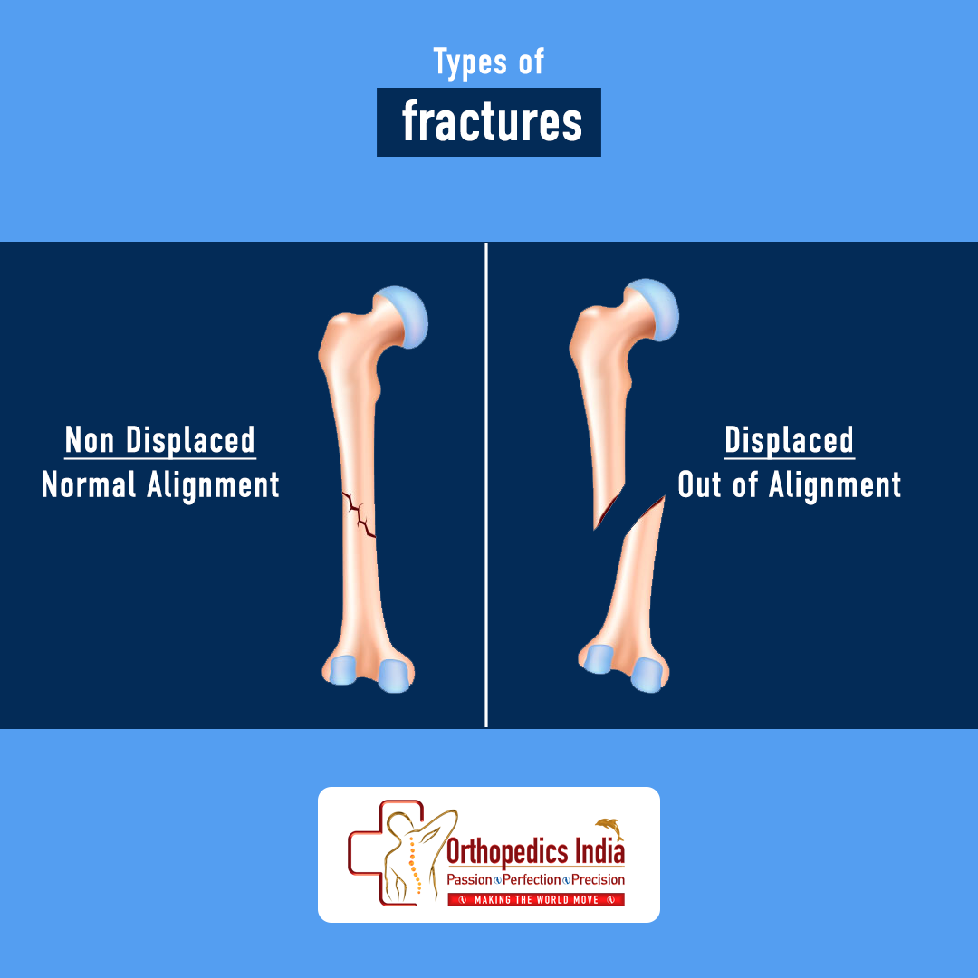 Orthopaedics India - Confused about the types of fractures? Some ...
