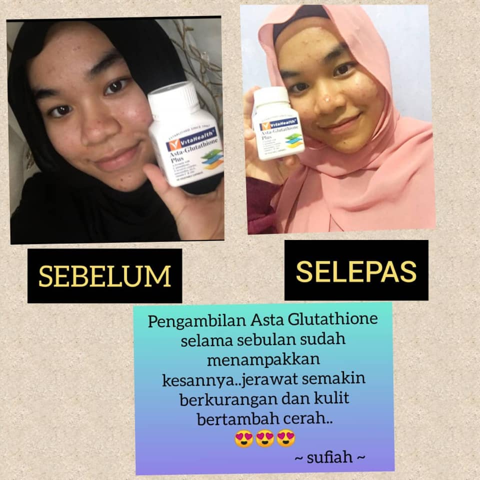 asta glutathione plus testimonial Bila anda cerita gelak2 tak percaya..diaorang gelak sebab ragu-ragu dengan keberkesanan Asta-Glutathion ni.. Ha tgk sendiri testimoni dari pengguna ni..Fuh lawa2 gebu licin skin kan..Tuuudia jangan terkejut sampai ternganga fulakk😆 MASALAH JERAGAT PATCHMD - Multi Plus Pack:110 gm Cardiovascular Support