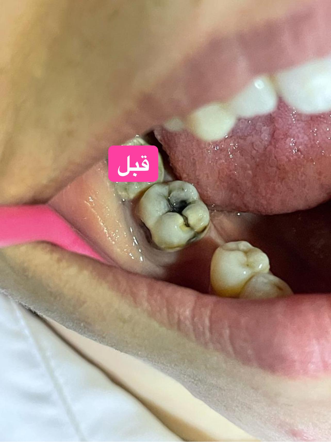 🦷 حشوات الجذور 🦷 السبب اللي يخلي... - مجموعة عيادات عرب | Facebook