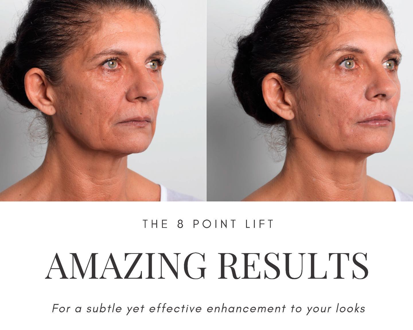 The 8 point lift 💫 Dr K uses the... - Ocean Medical Clinic