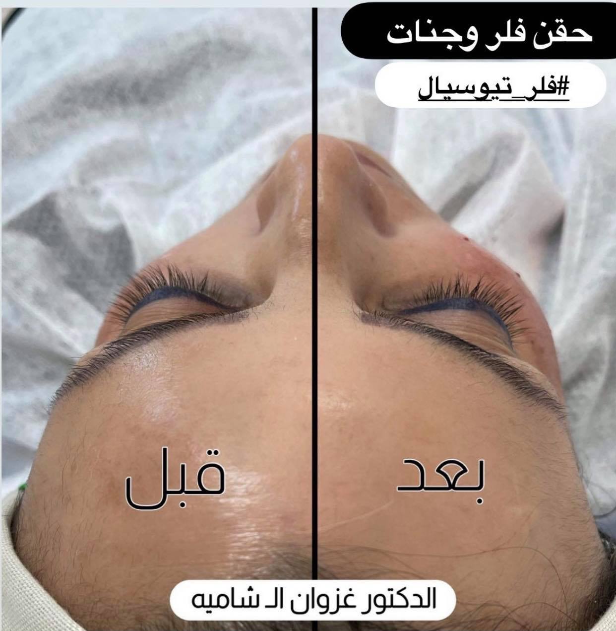 حقن #فلر_تيوسيال_السويسري... - Teoxane Iraq فلر تيوسيال | Facebook
