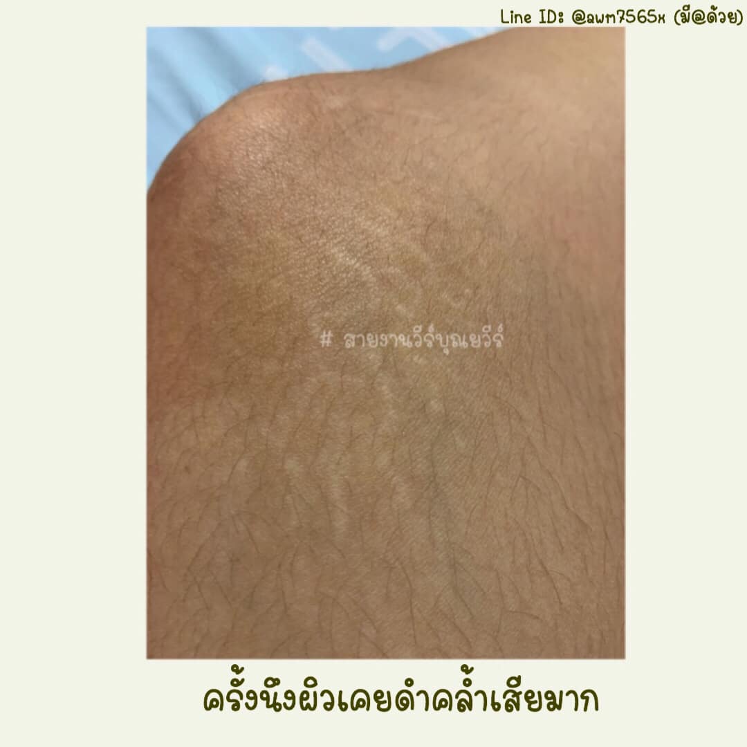 พูดถึงรอยแตกลาย... - Pureblink เพจหลักดูแลความงาม | Facebook
