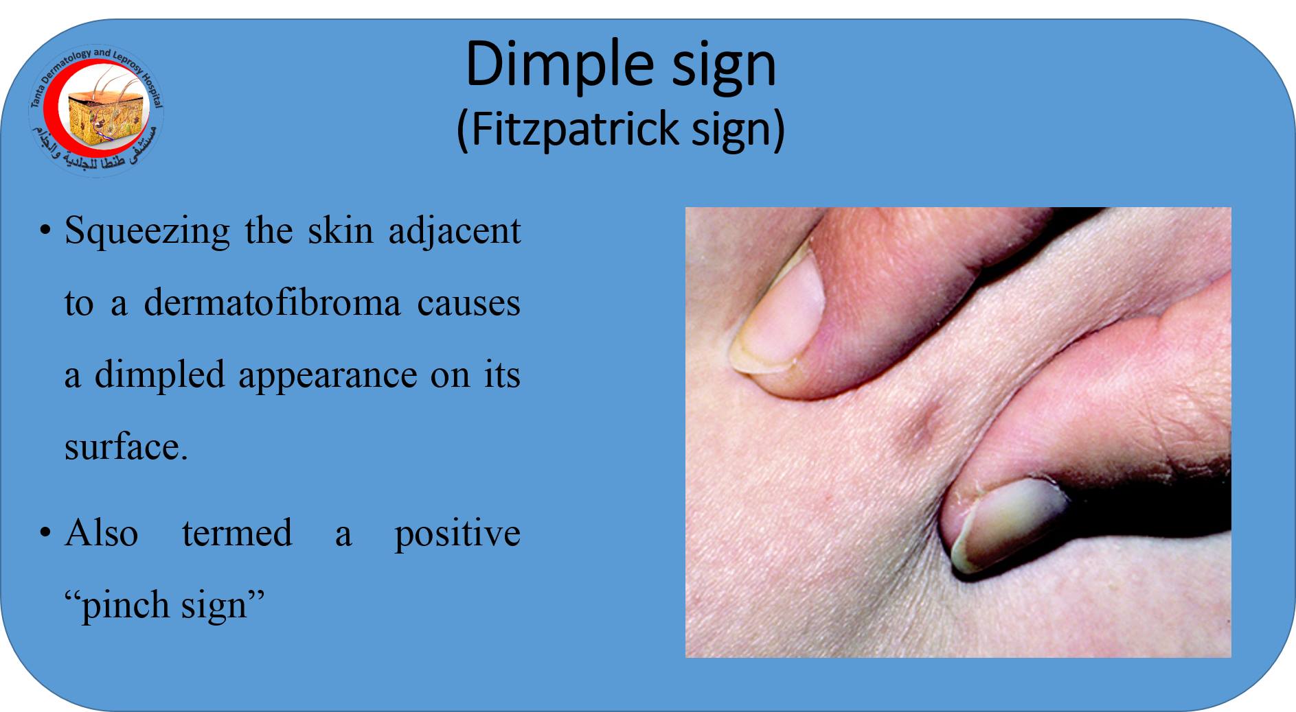 Dermatofibroma Dimple Sign