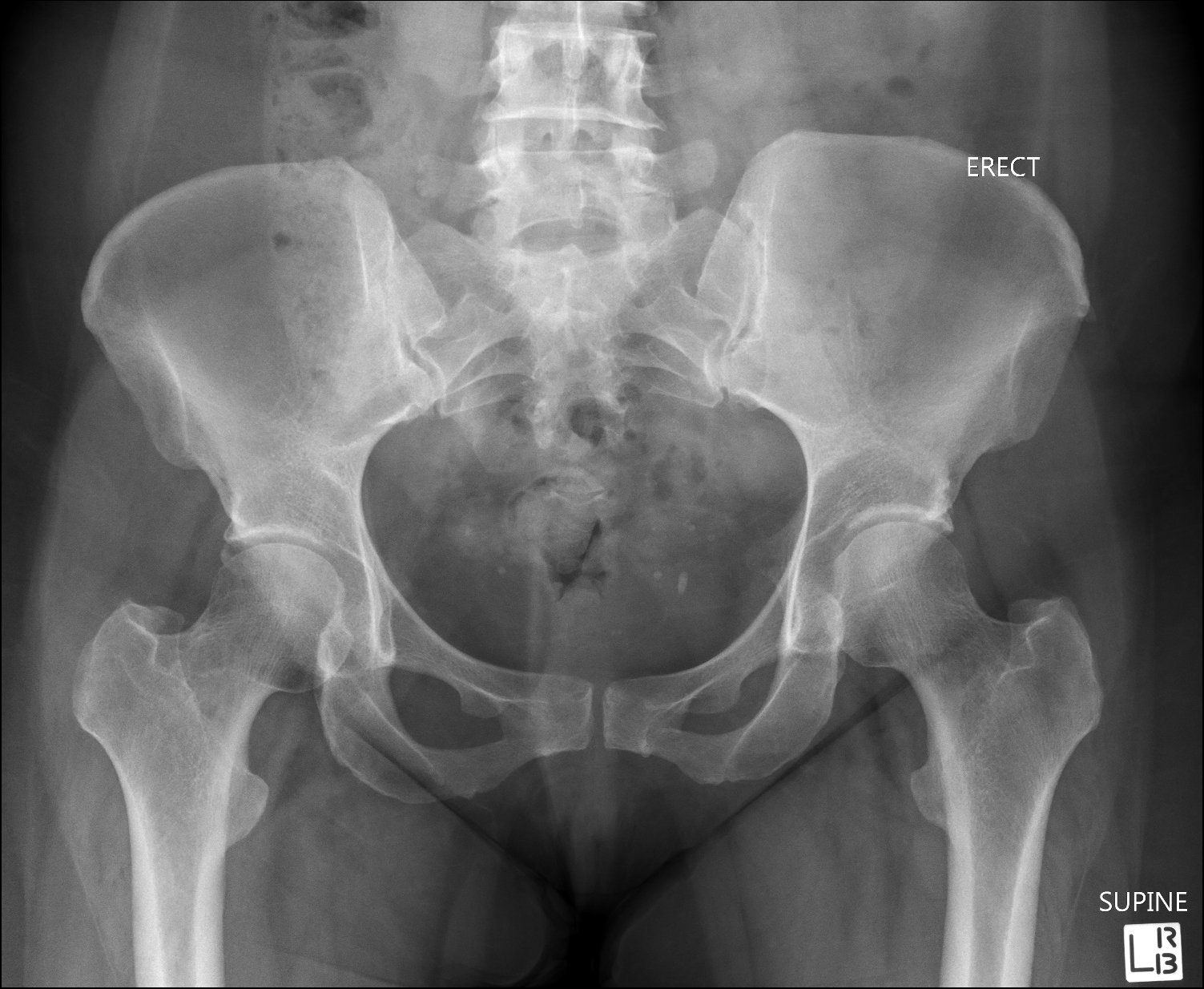 A subtle acetabular rim... - Riverside Medical Imaging | Facebook