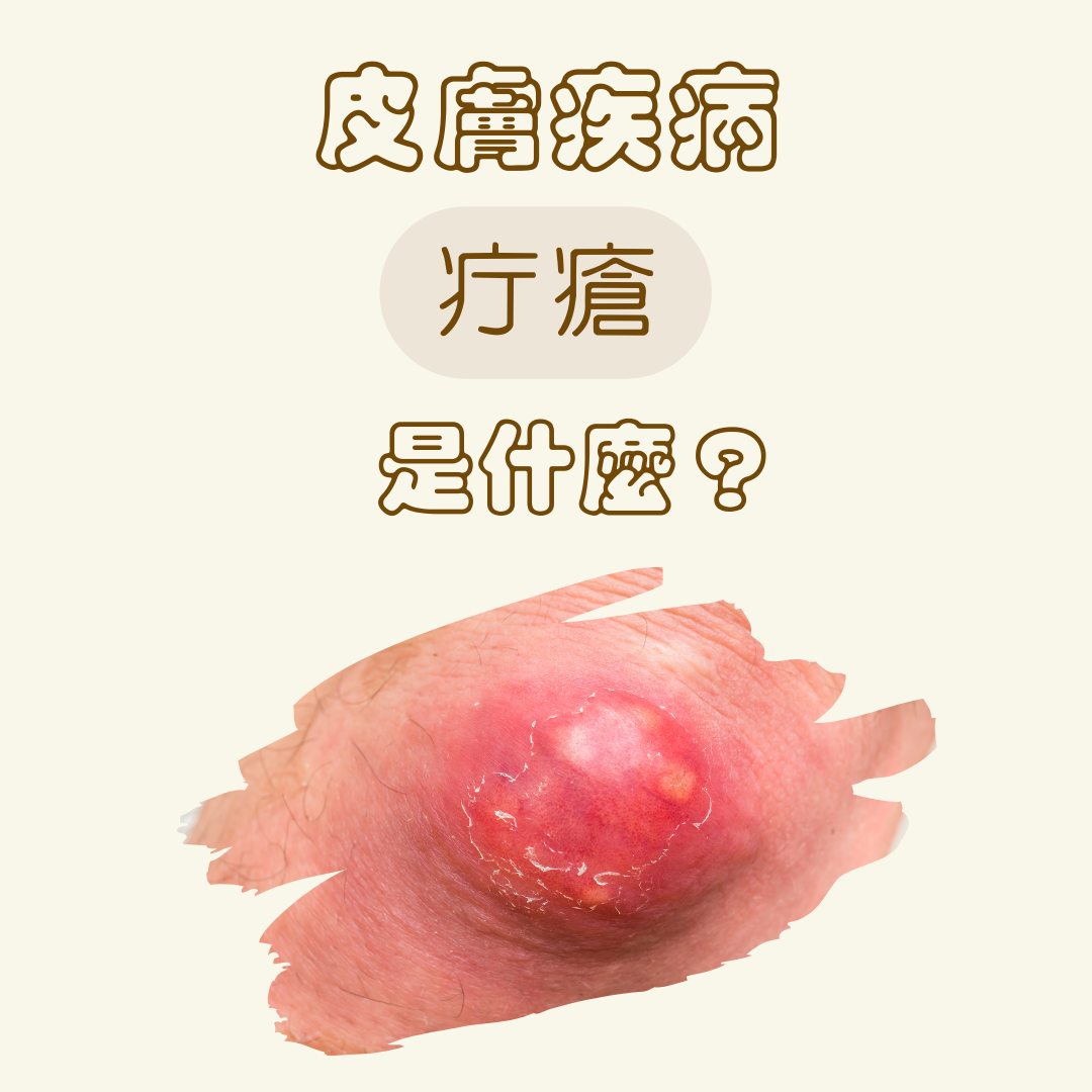 美上美皮膚科-醫學美容 - 你有聽過 #疔瘡 嗎？#疔瘡 是皮膚科很常見的疾病，在民間稱為 #長釘子 ，皮膚上會發生... | Facebook