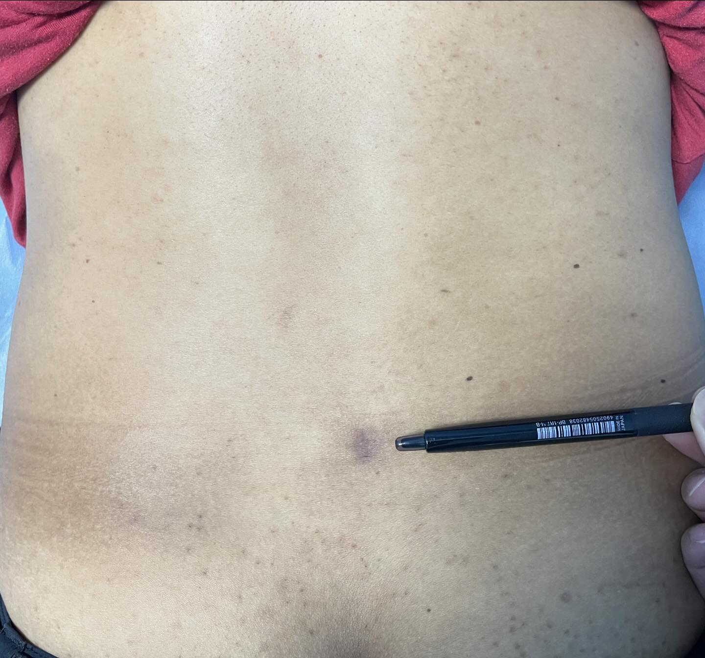 Dr - ***Minimally invasive surgery (MIS) in spine surgery*** Small ...