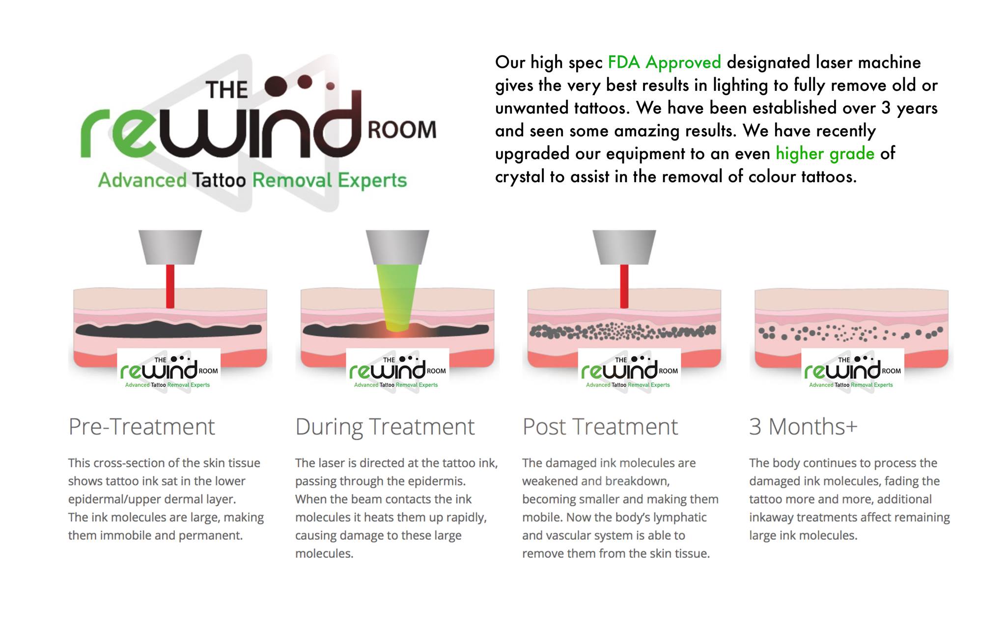 The Rewind Room Advanced Tattoo Removal | Sheffield