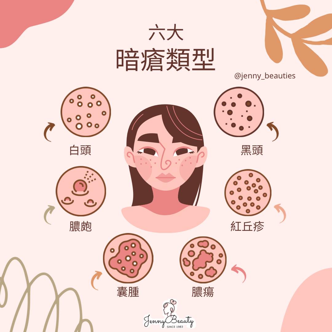 一粒無頭暗瘡～新治療篇～ 無頭痤瘡特點是：紅，腫，痛！獨立個體，無頭，唔會熟㗎... - 珍妮閣 （暗瘡 脫墨 男仕修眉） | Facebook