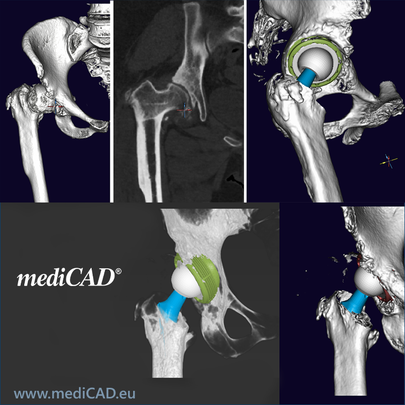 mediCAD 3D Hip A powerful tool in... - mediCAD Hectec GmbH | Facebook
