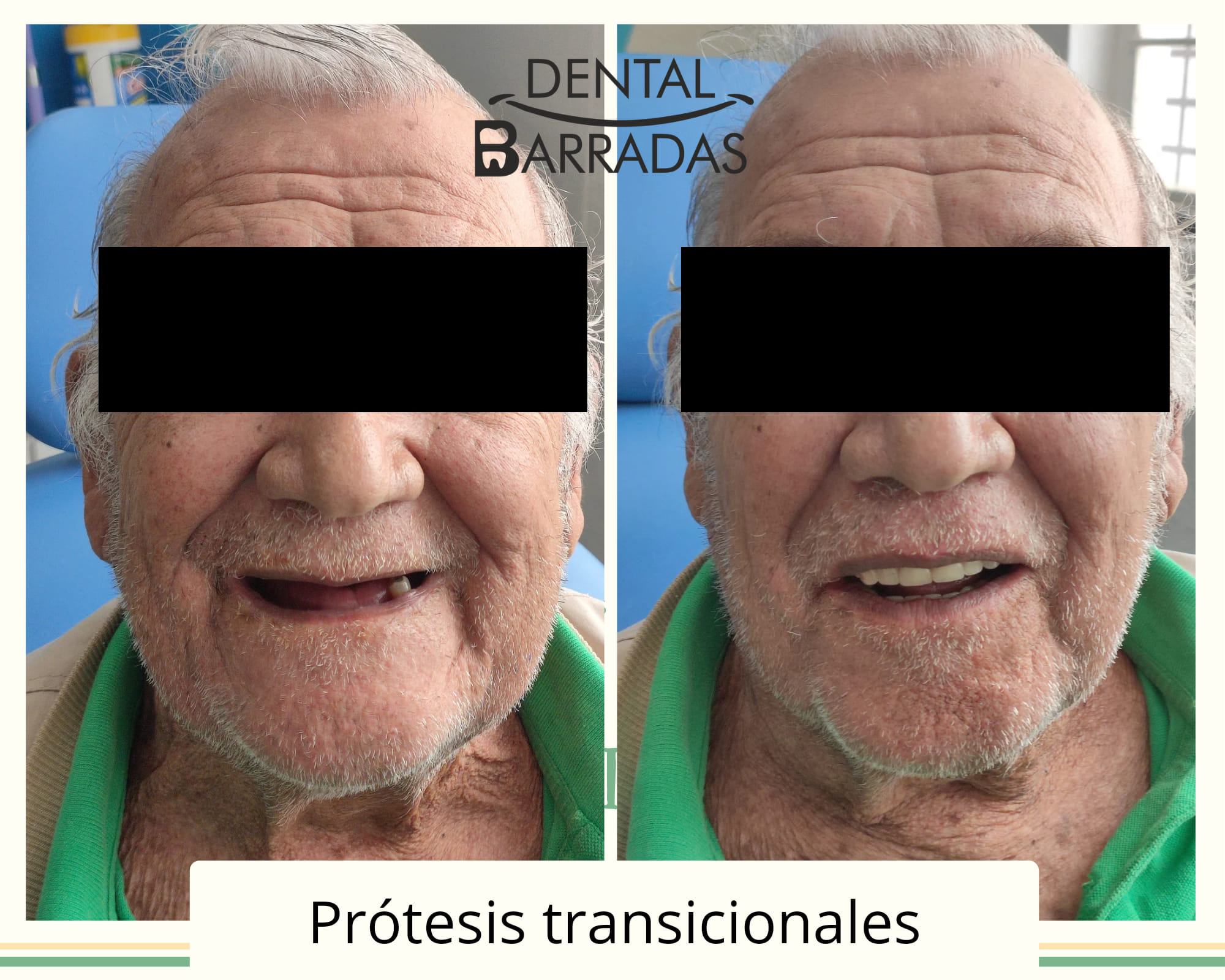 Dental Barradas - Prótesis Inmediata o transicional.🦷🦷🦷... | Facebook