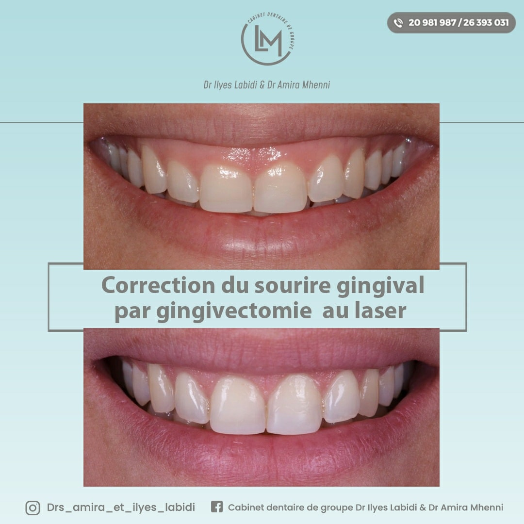 Correction du sourire gingival par gingivectomie au laser ...