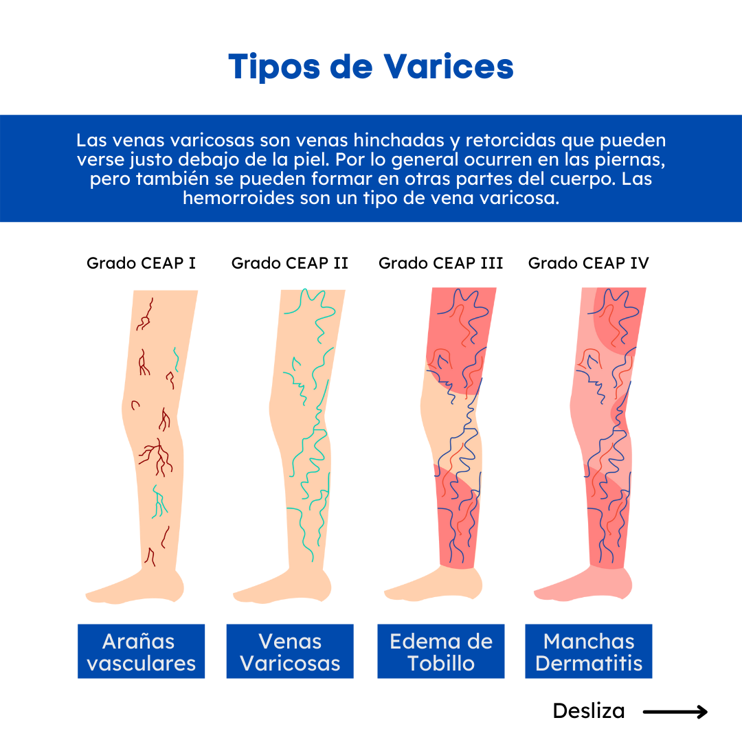 ¡Tipos de varices! Existen... - Ortopedias Más Vida