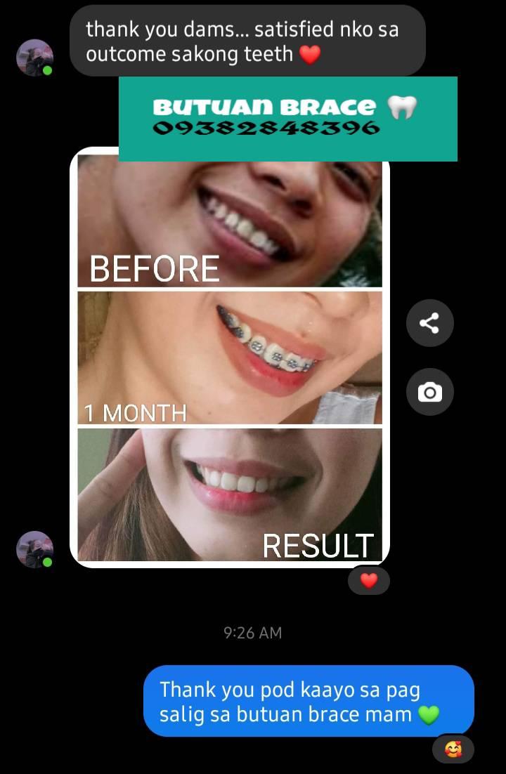 Butuan braces | Butuan City