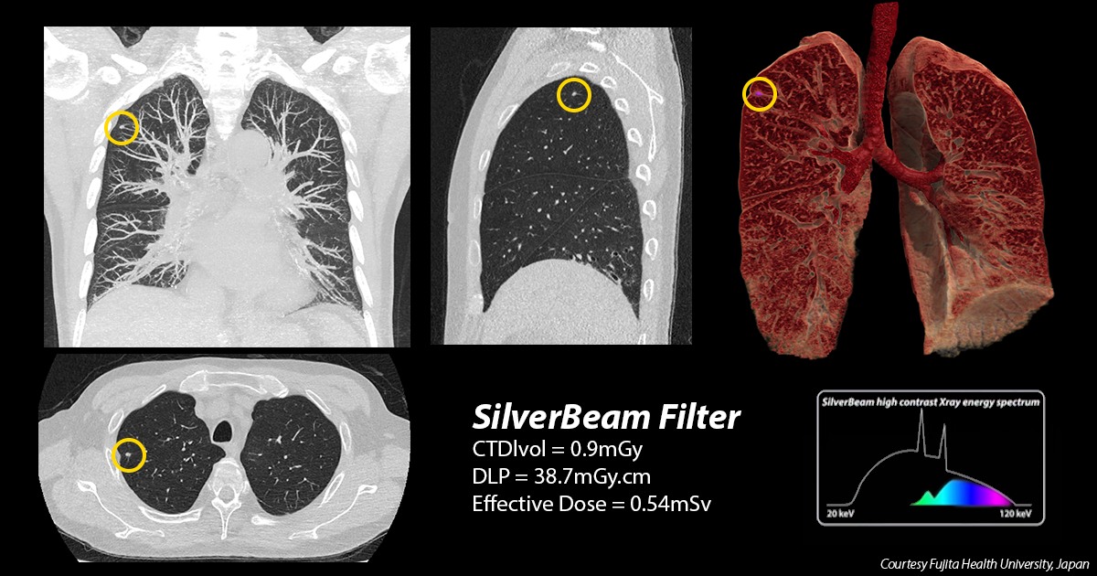 #Lungcancer is one of... - Canon Medical Systems Corporation