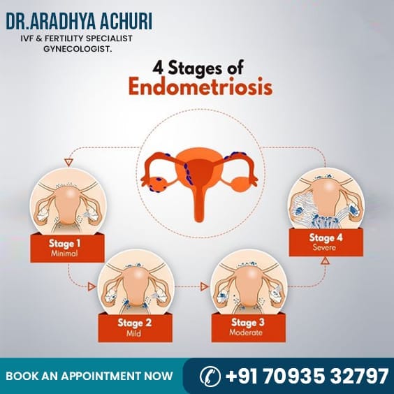 draradhyaachuri - The 4 stages of Endometriosis....