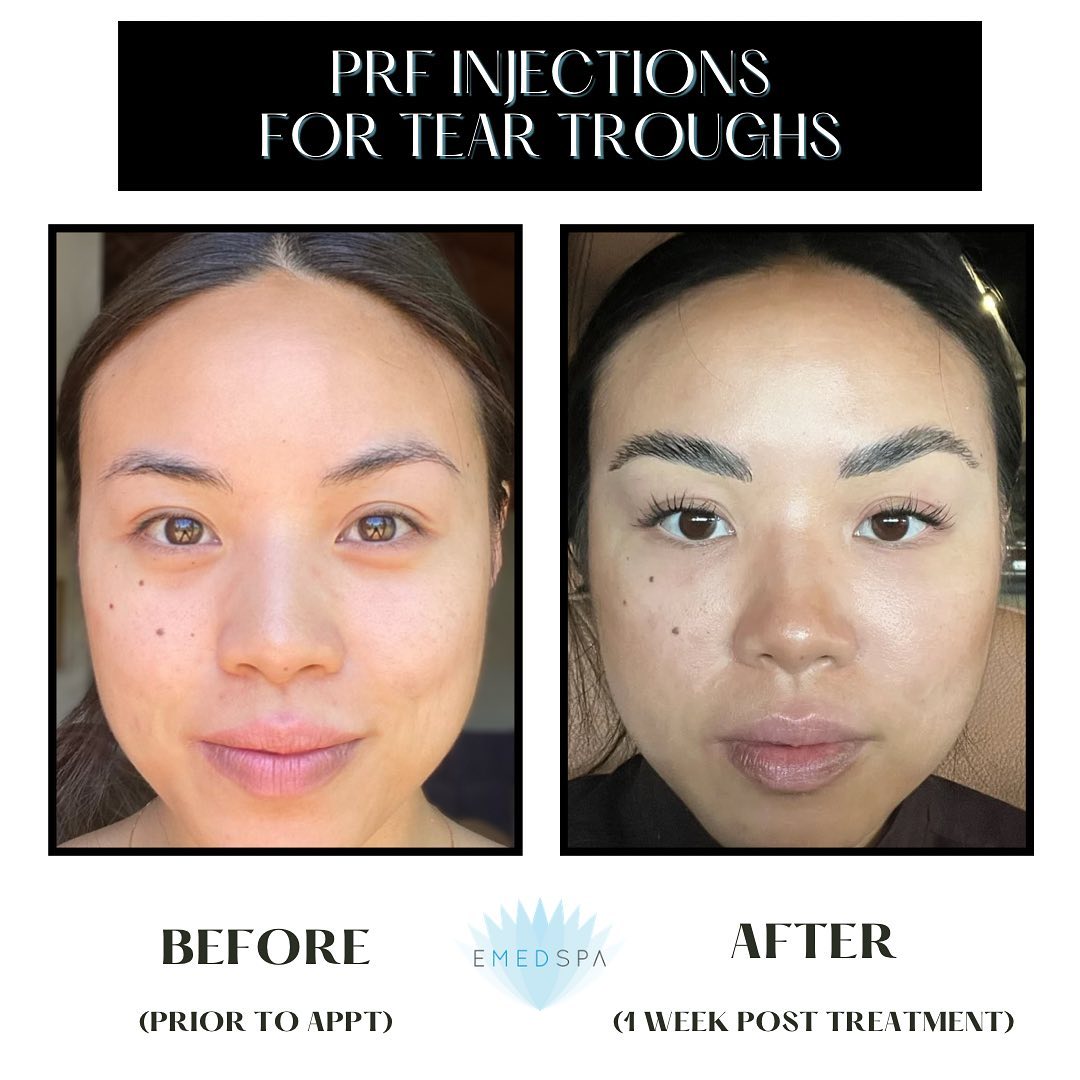 E Med Spa - Platelet Rich Fibrin (PRF) AKA natural filler... | Facebook