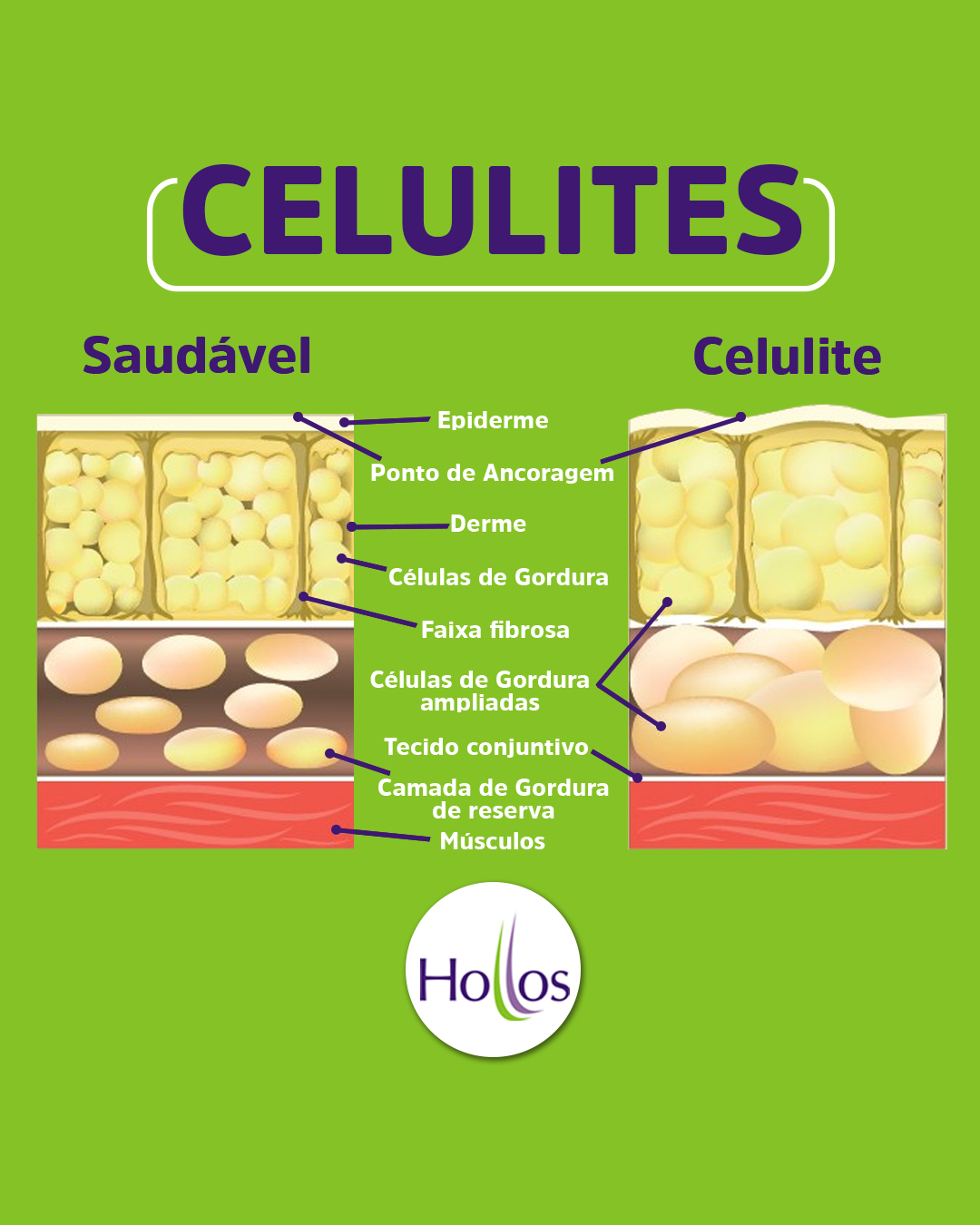 Clínica Hollos - O que causa a celulite? Entre os...