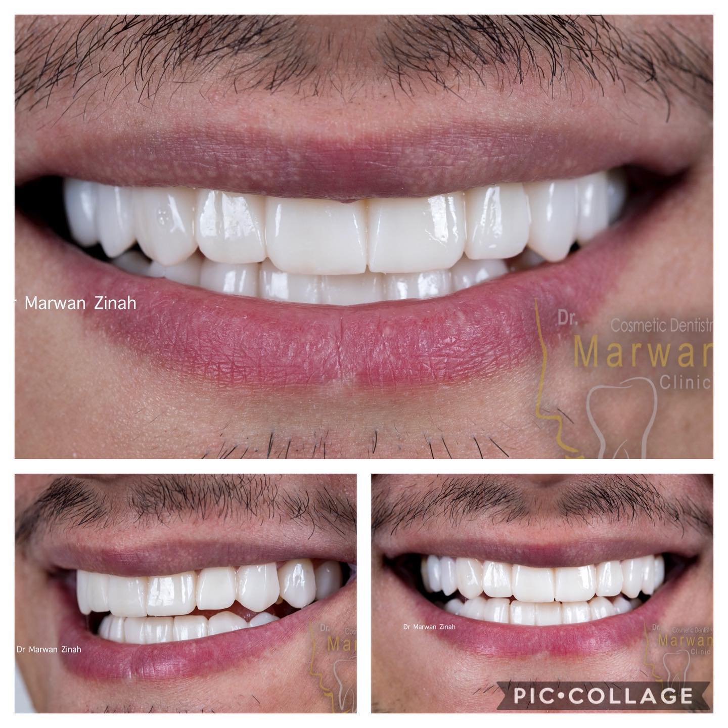 د مروان زينة الصفحة الرسمية - Emax veneers without prep عدسات الايماكس ...