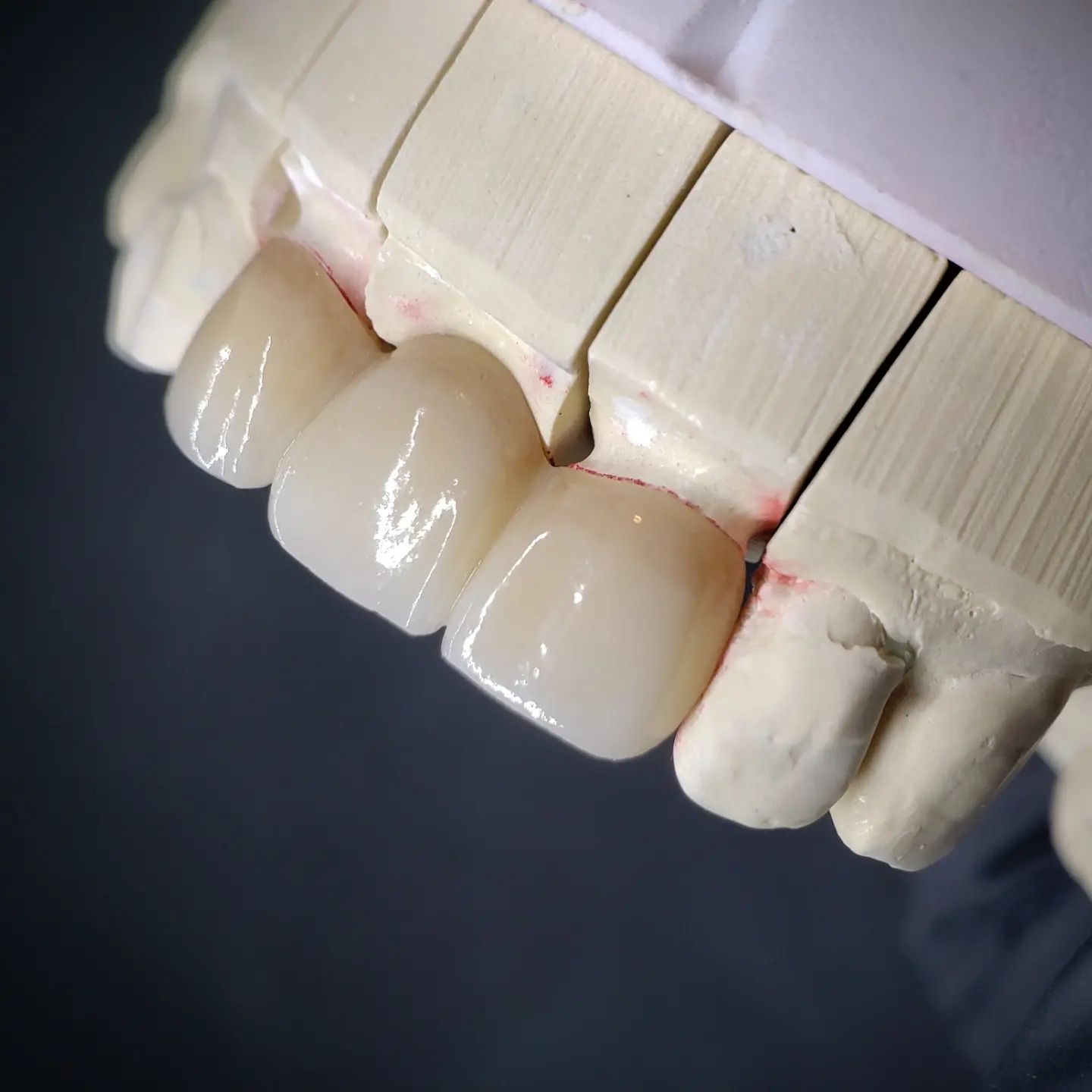 A... - Crown & Bridge International - Dental Laboratory