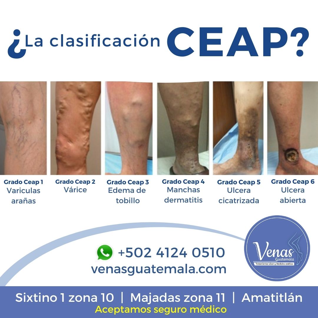 Clínica de Venas del Dr Nery Orozco - ¿QUE ES LA CLASIFICACIÓN CEAP? Es ...