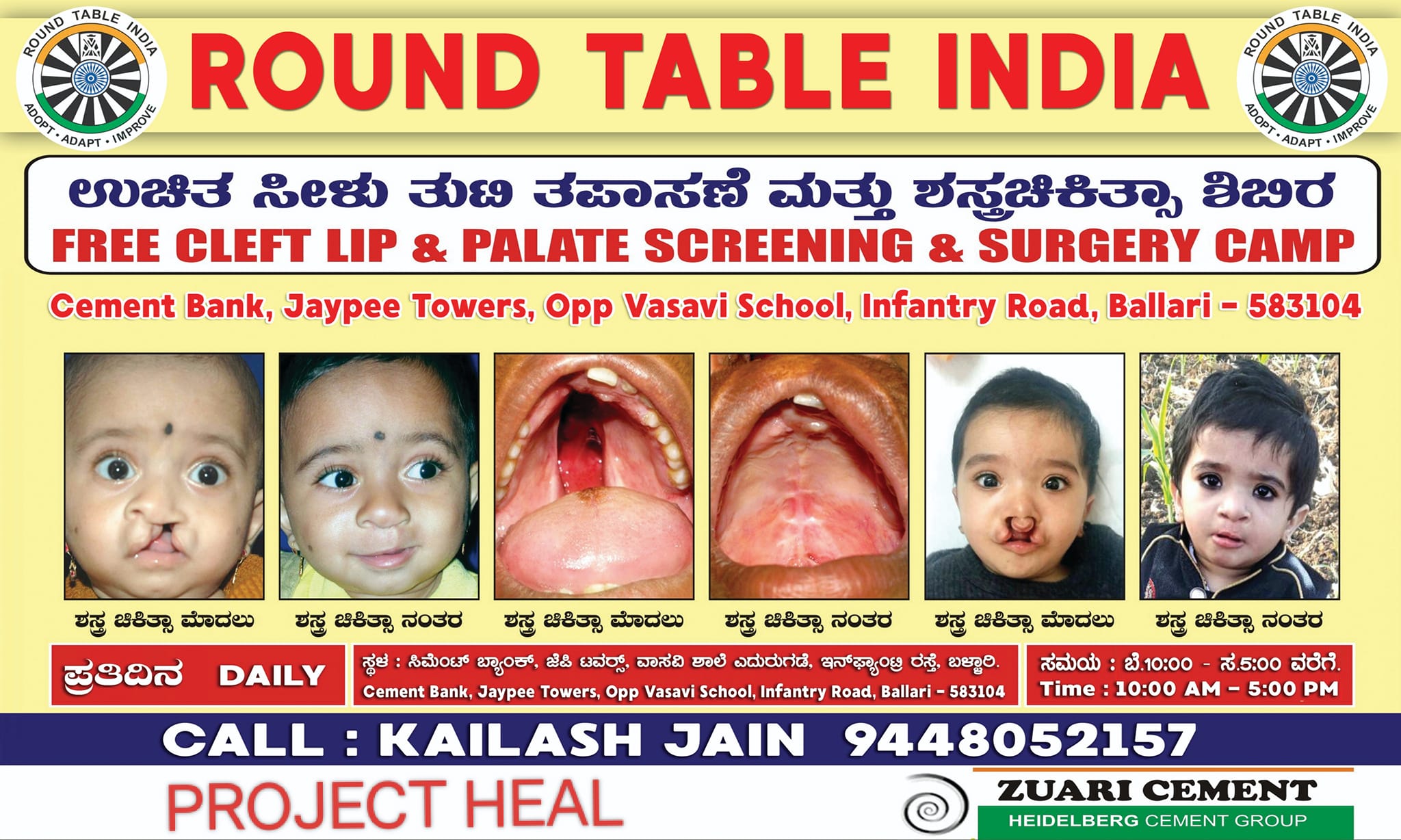 Free Cleft Lip & Palate Surgary | Ballari