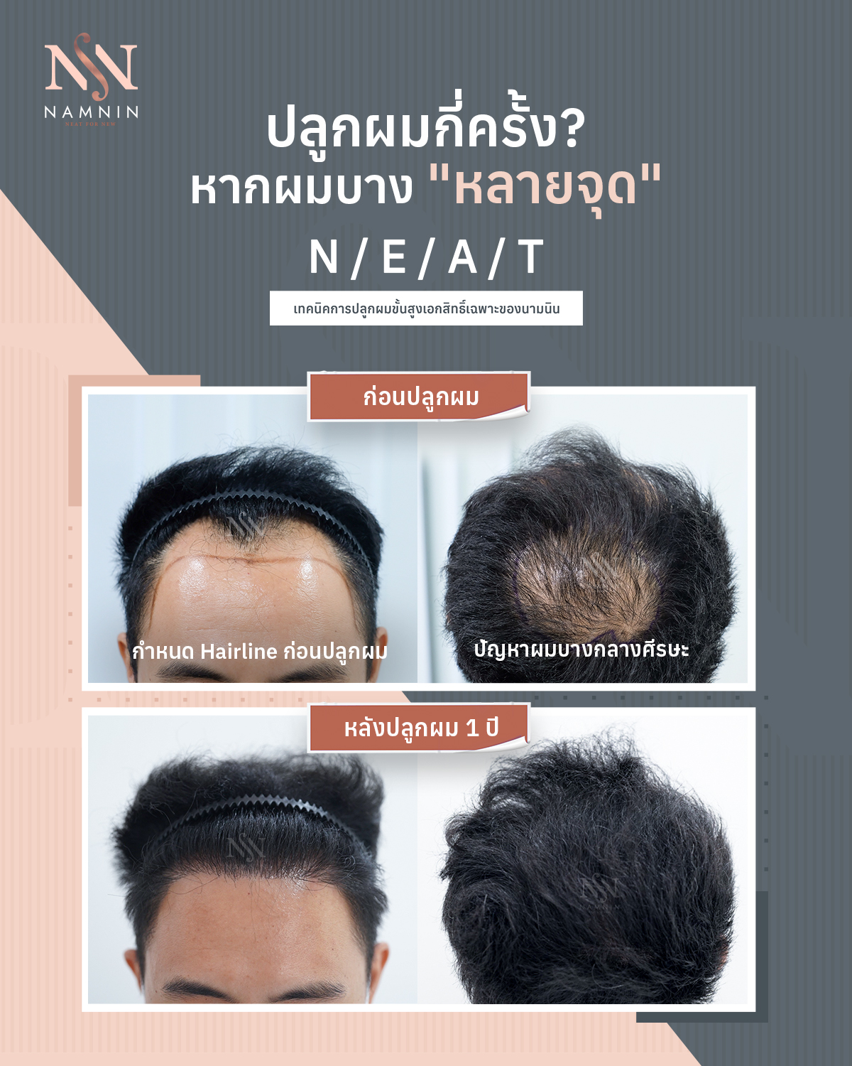 Namnin ForV clinic ปลูกผมถาวรเทคนิค NEAT โดยแพทย์ทุกกราฟ | Facebook