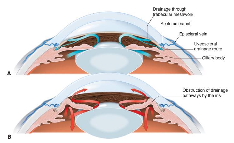 Ophthalmology-Notes - Aqueous Humor Flow: ️A, Normal flow of aqueous ...