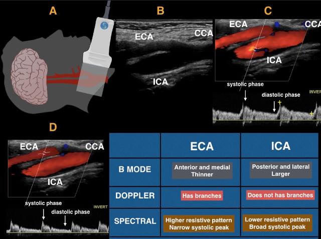 💡Tips for differentiating the ICA from... - Salus sonography | Facebook