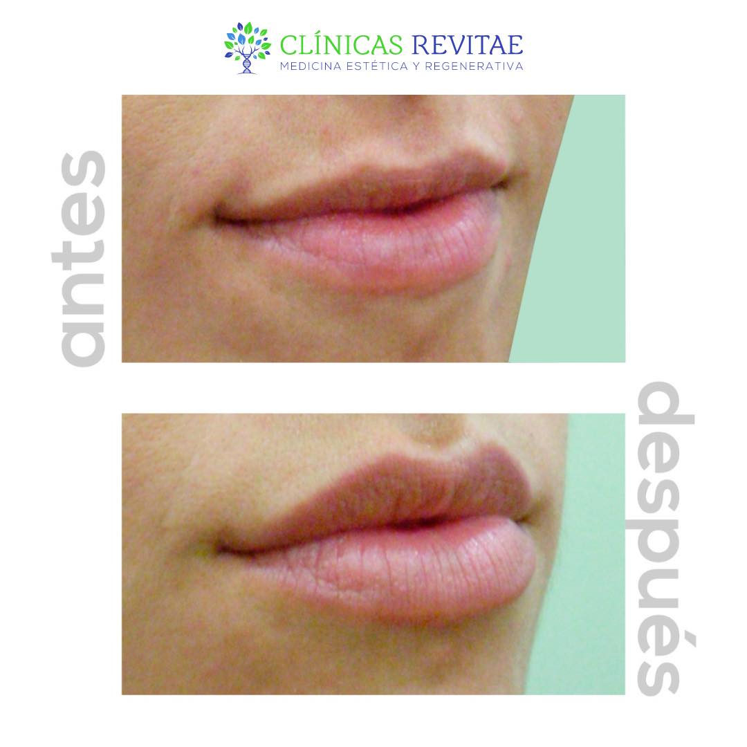 💚 Labios perfectos: una ecuación para... - Clínicas Revitae | Facebook