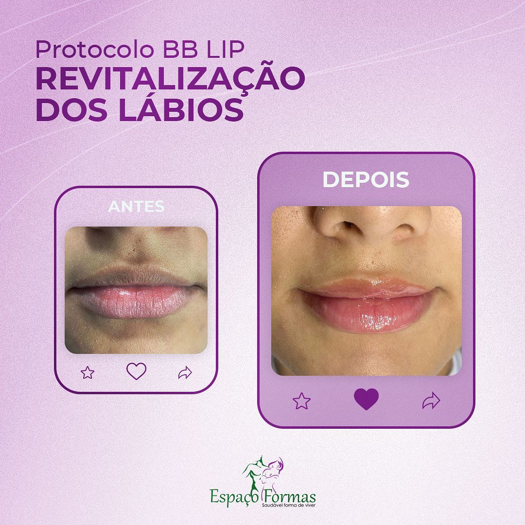 Que tal ter seus lábios super... - Clínica Espaço Formas