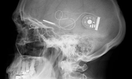Some - This retinal implant 'Alpha IMS device' has given sight to 9 ...