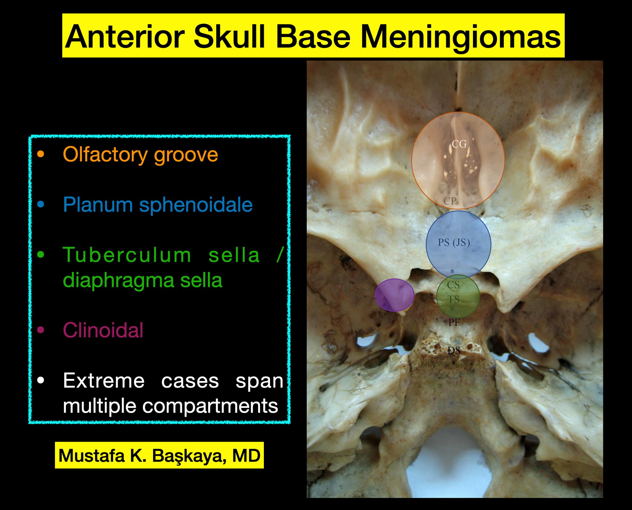 📌 Anterior Skull Base Meningiomas: Classification and