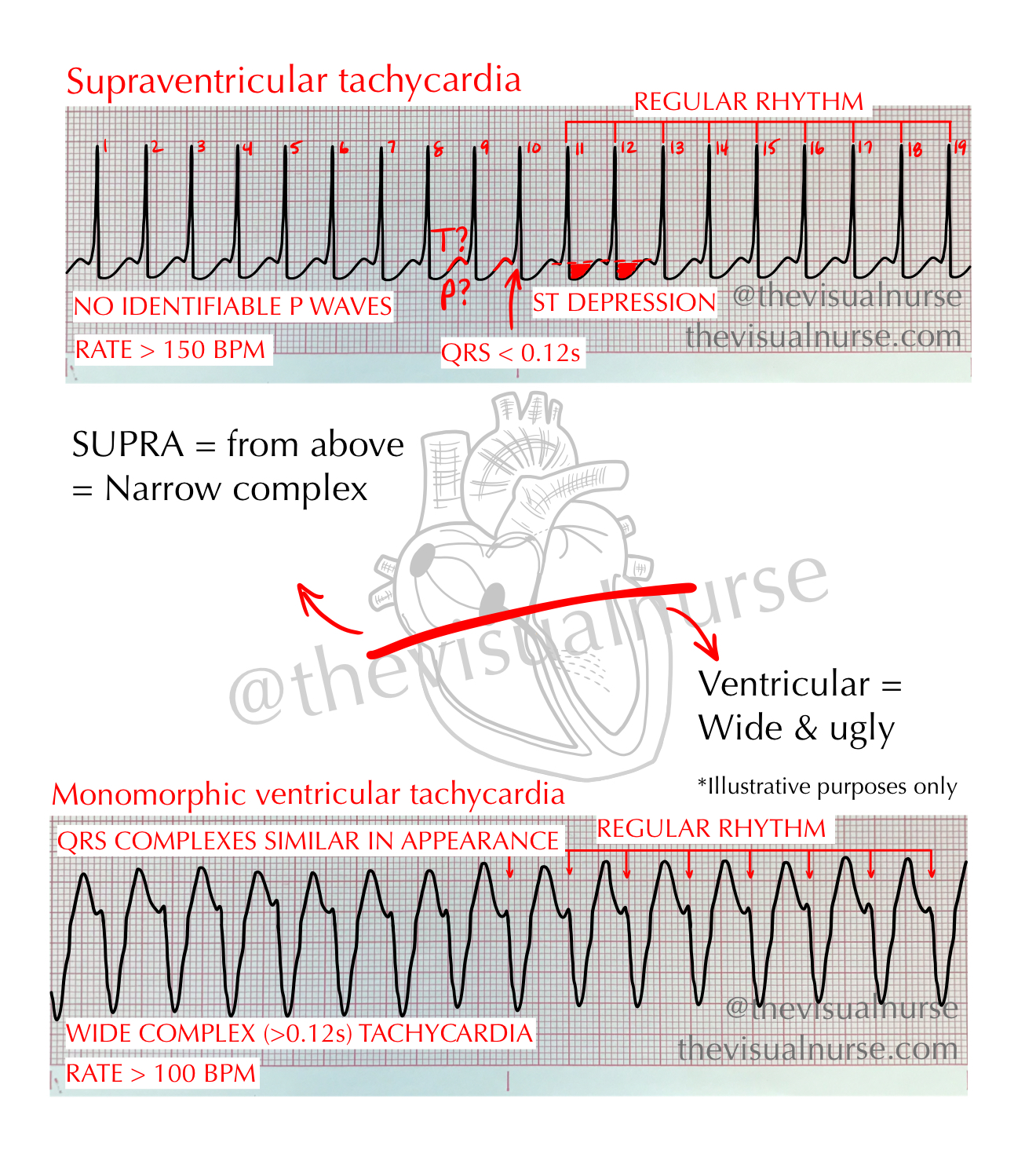CardioVisual - VT versus SVT at a glance 💨 Similarities ️FAST ️No ...