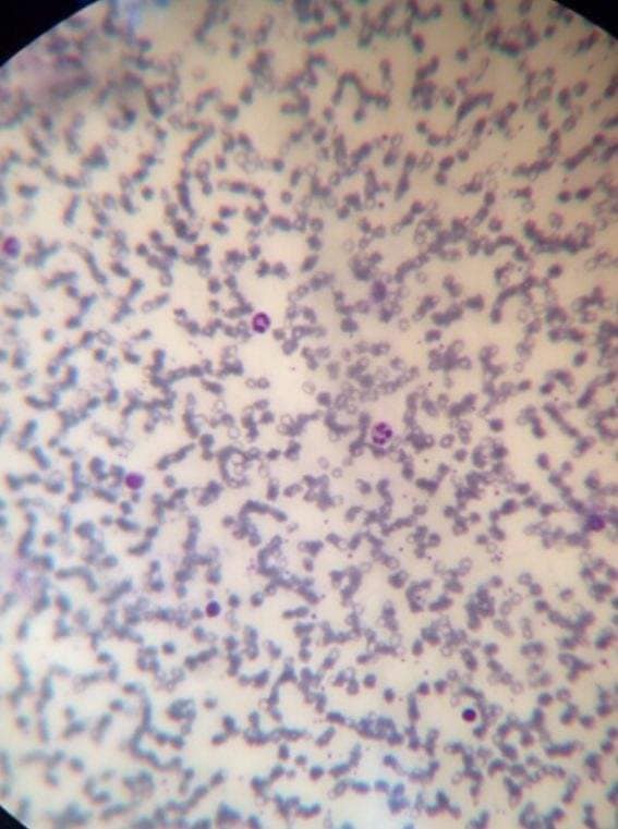 เซล์เม็ดเลือดแดง (Red blood cell,RBC) และเซลล์เม็ดเลือดขาว (White blood ...