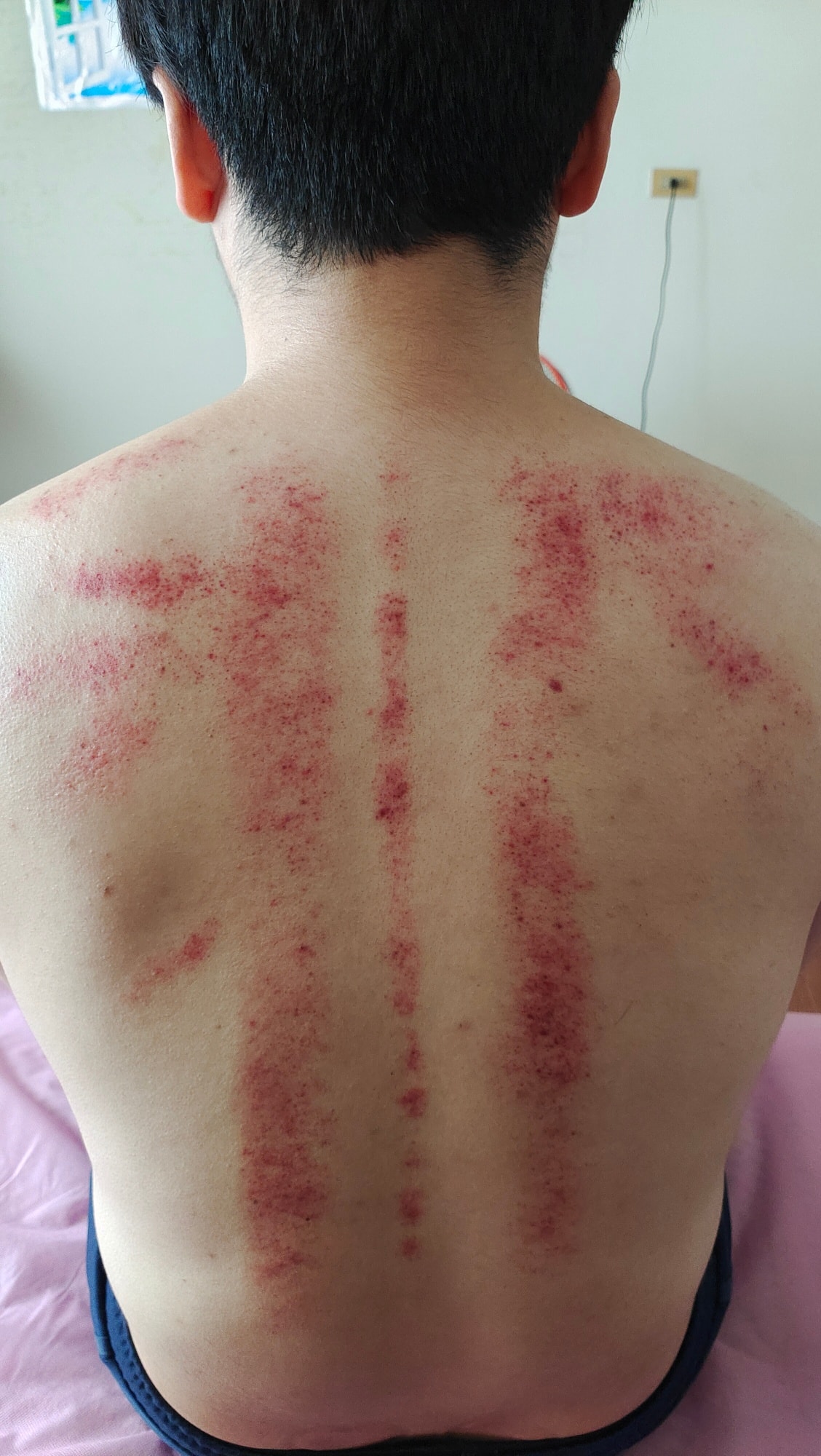 台南大叔洪梓傑-身心修護所 - 這位先生的痧證看起來並不算多 但是這不一定就代表身體好 因為在我們刮痧之前都會先做基本的肌肉舒緩在做肌肉舒緩 ...