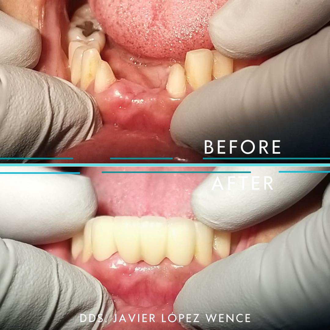 Dentista Javier López Wence - Los puentes son prótesis dentales que ...