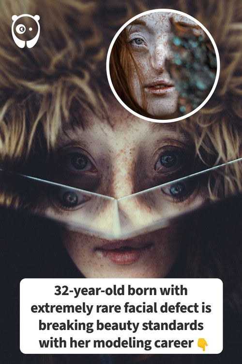 The Humor - 32-year-old born with extremely rare facial defect is ...