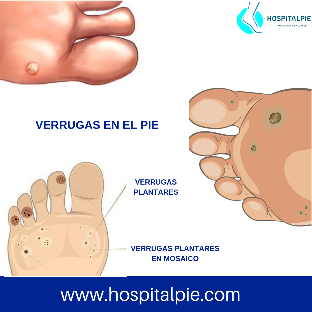 Hospitalpie - Las verrugas plantares, son producidas por...