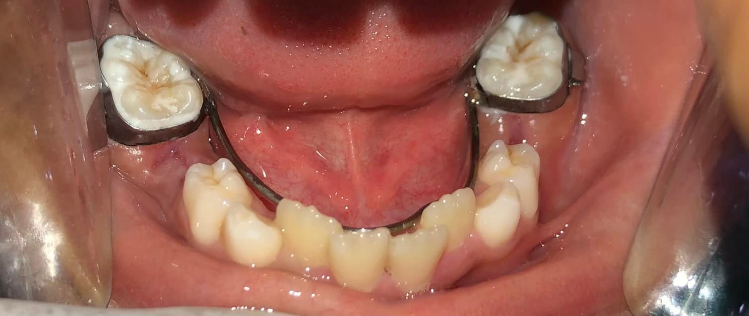 Chirayu - What is lingual holding arch? The lower lingual holding arch ...