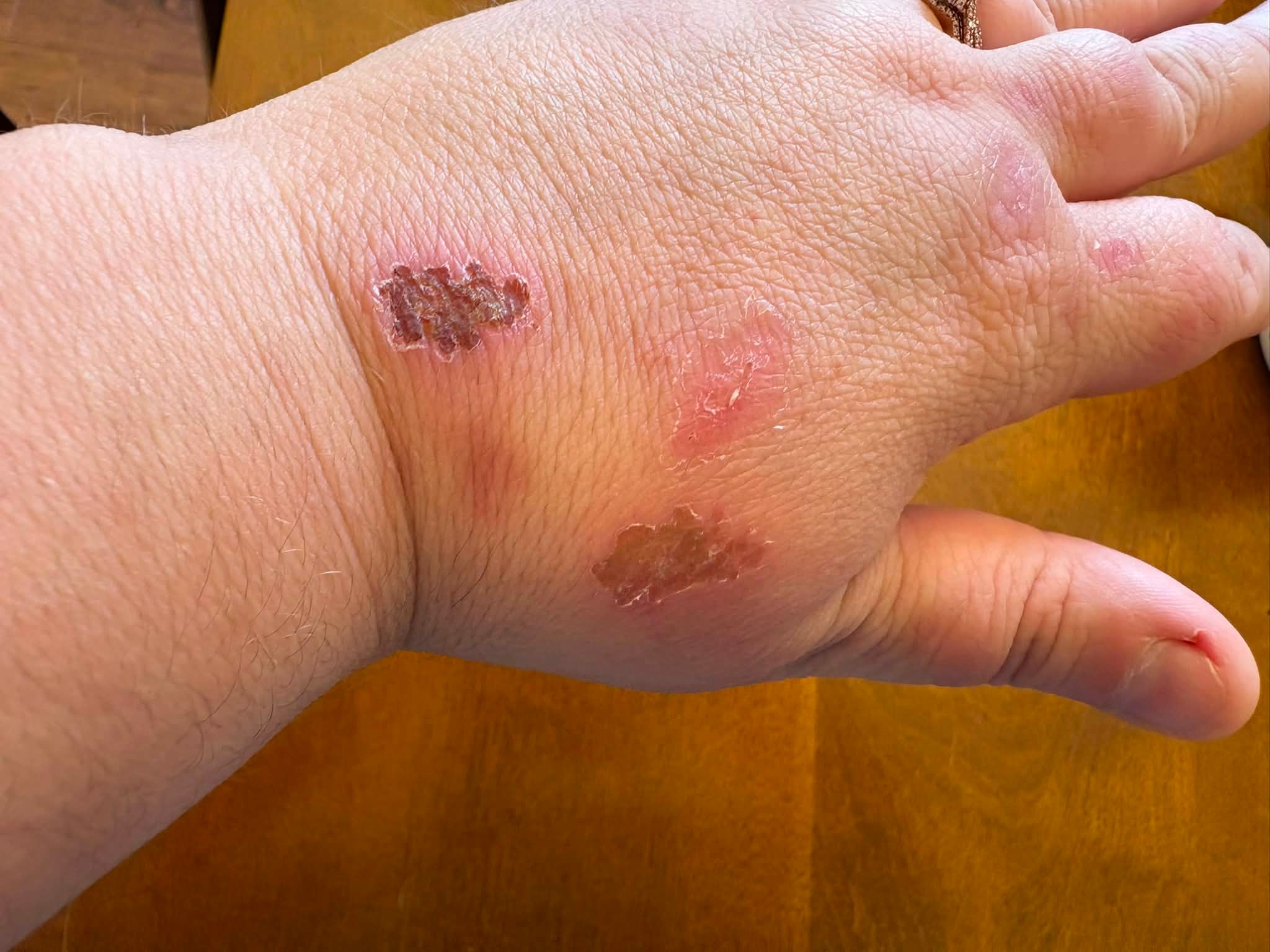 Anyone else here on tirzepatide? Ever since I have been taking it and losing weight along with going to the gym 5 days a week, my hands have been completely clear despite