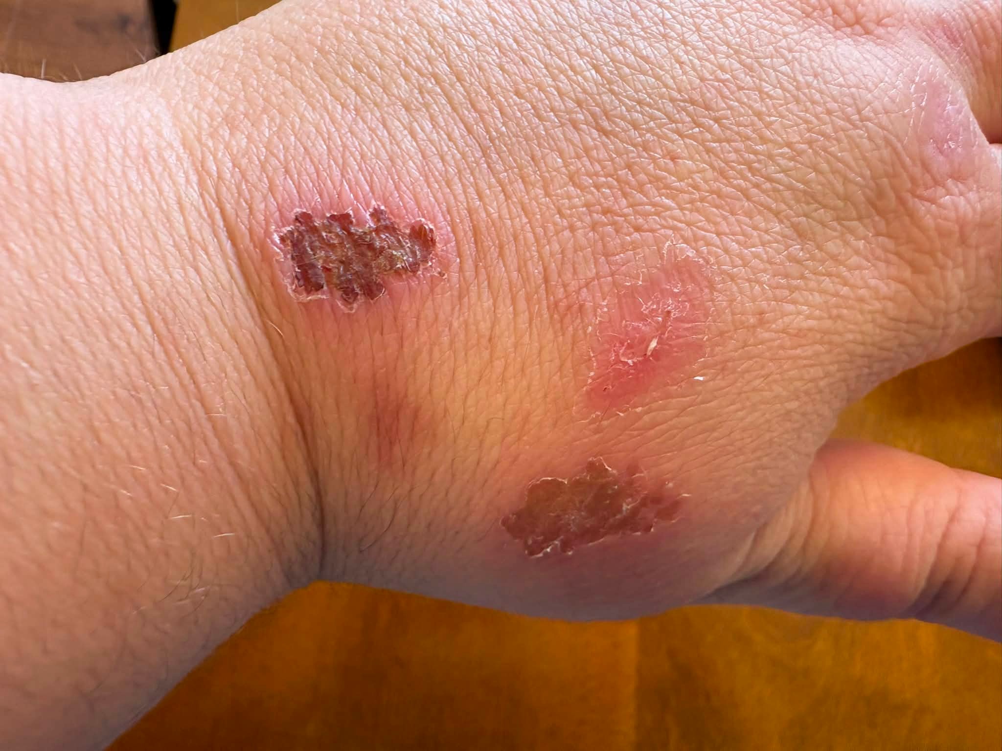 Anyone else here on tirzepatide? Ever since I have been taking it and losing weight along with going to the gym 5 days a week, my hands have been completely clear despite